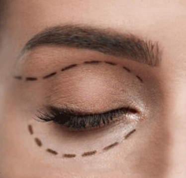 neinvaznivni bleferoplastika